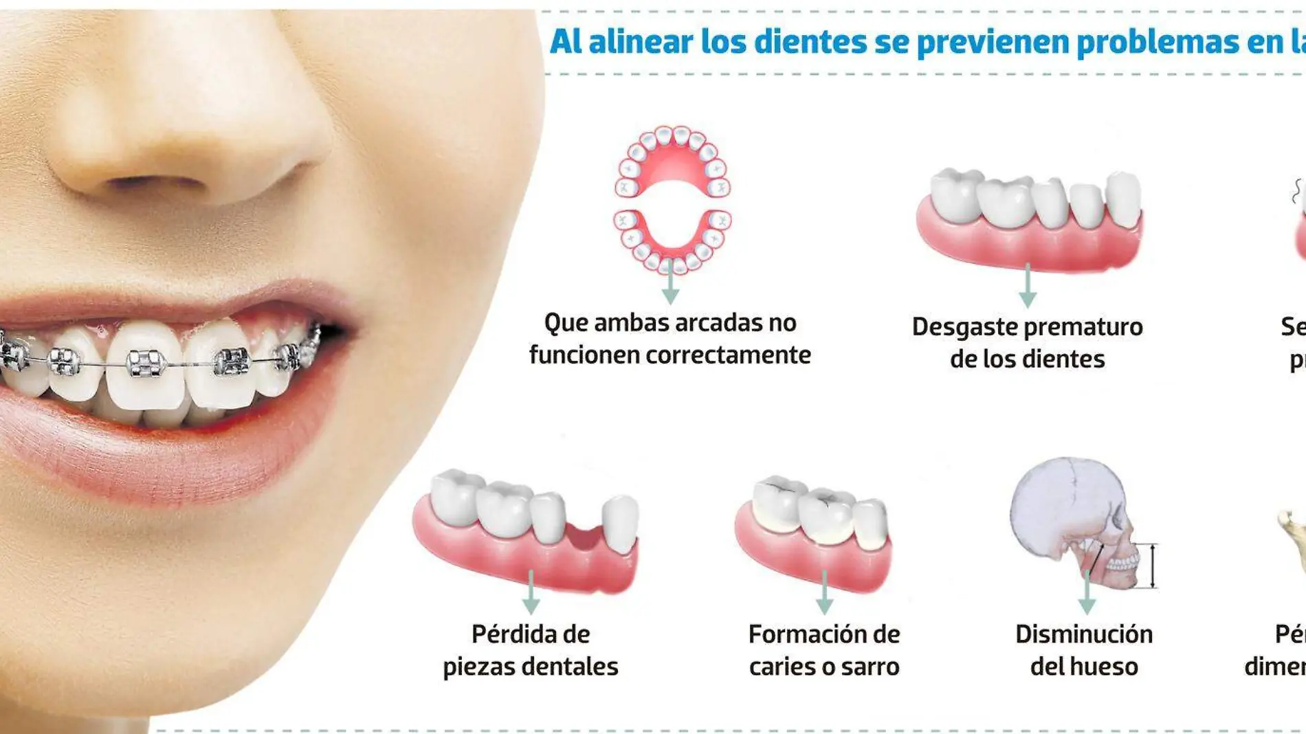 infografia brackets 